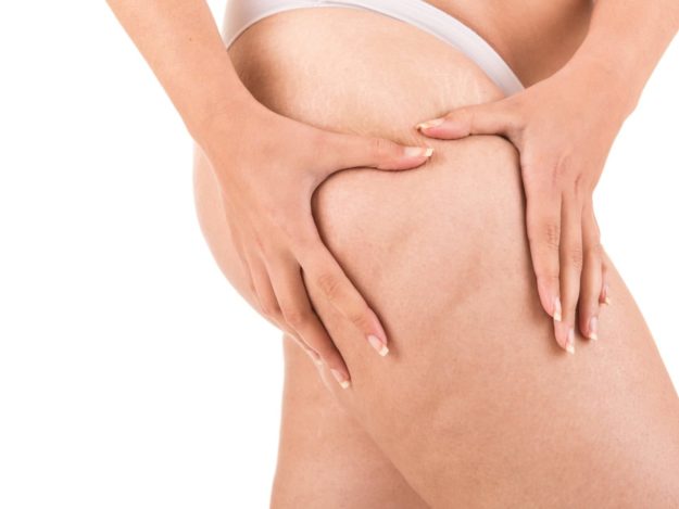 menopause and cellulite менопауза и целулит